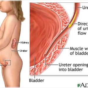 Bladder Inflammation Information - Cranberry Juice Helps Prevent Urinary Tract Infections