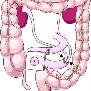 Urinary Tract Infections Symptoms - UTI Symptoms And Treatment For Men 