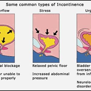 Info On Urinary Tract Infections - How To Cure UTI Without Medications - 6 Remedies That Work